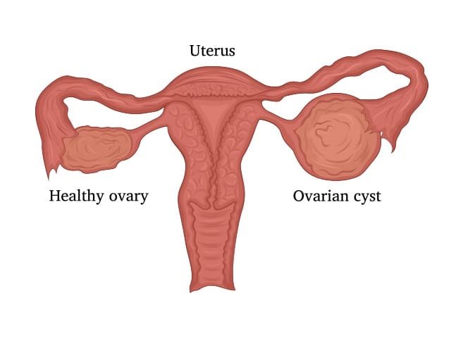 Ovarian Cysts: How do they cause miscarriage? – Antai Hospital