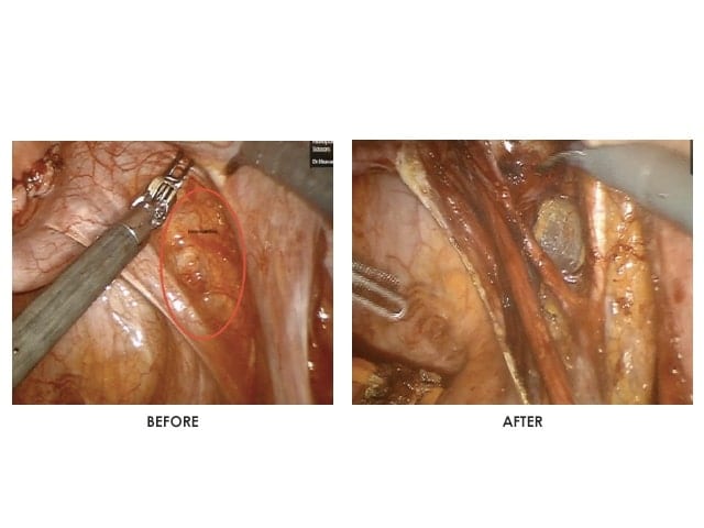 Laparoscopic Endometriosis Surgery